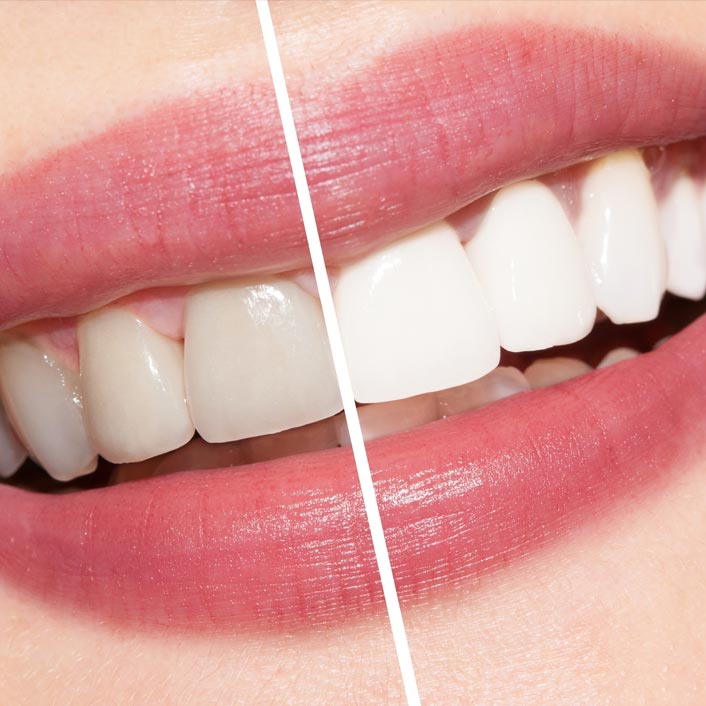 Whitening Trays - Dental Services